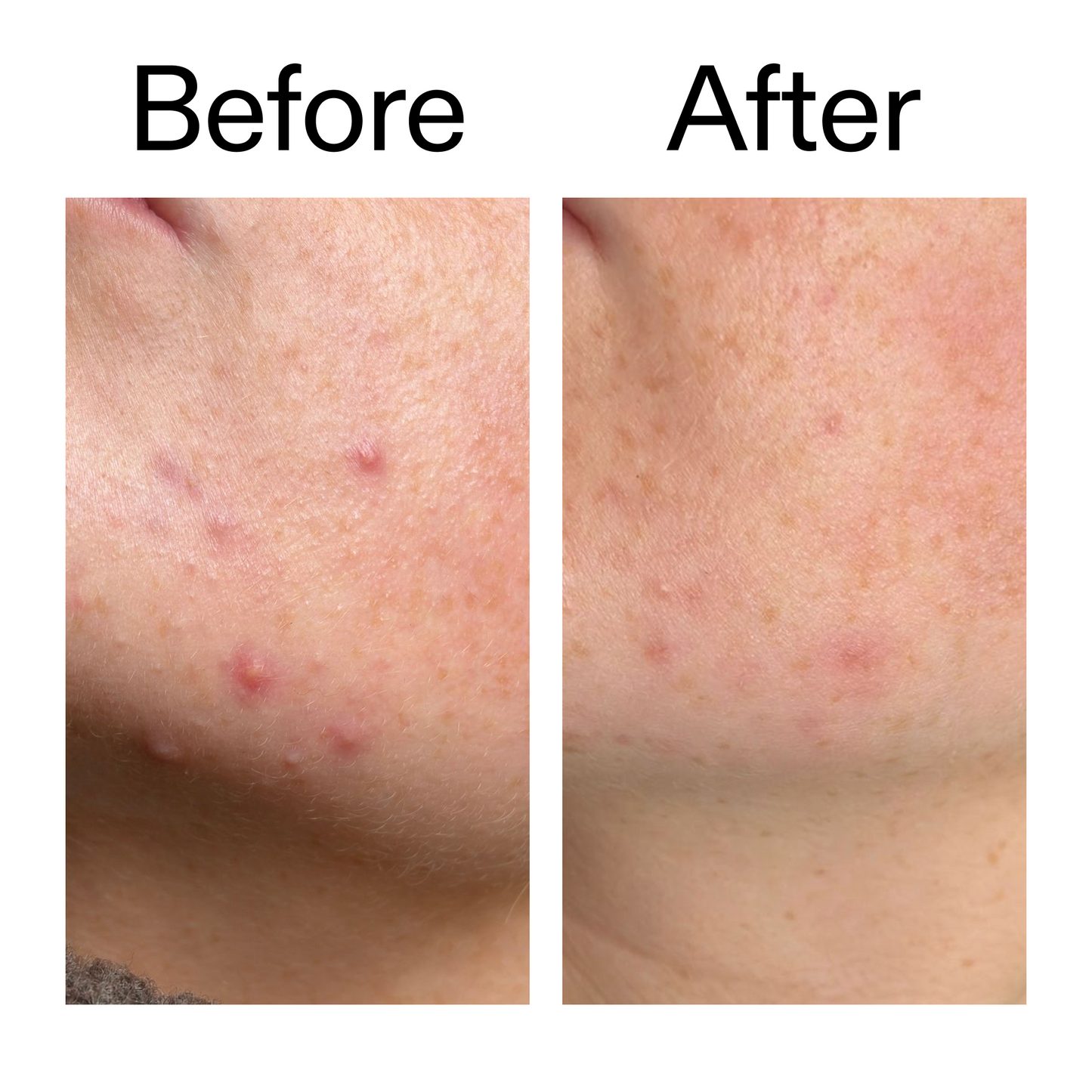 10-azelaic-acid-serum-for-redness-relief-l3 B_A_1_PPAGE.png