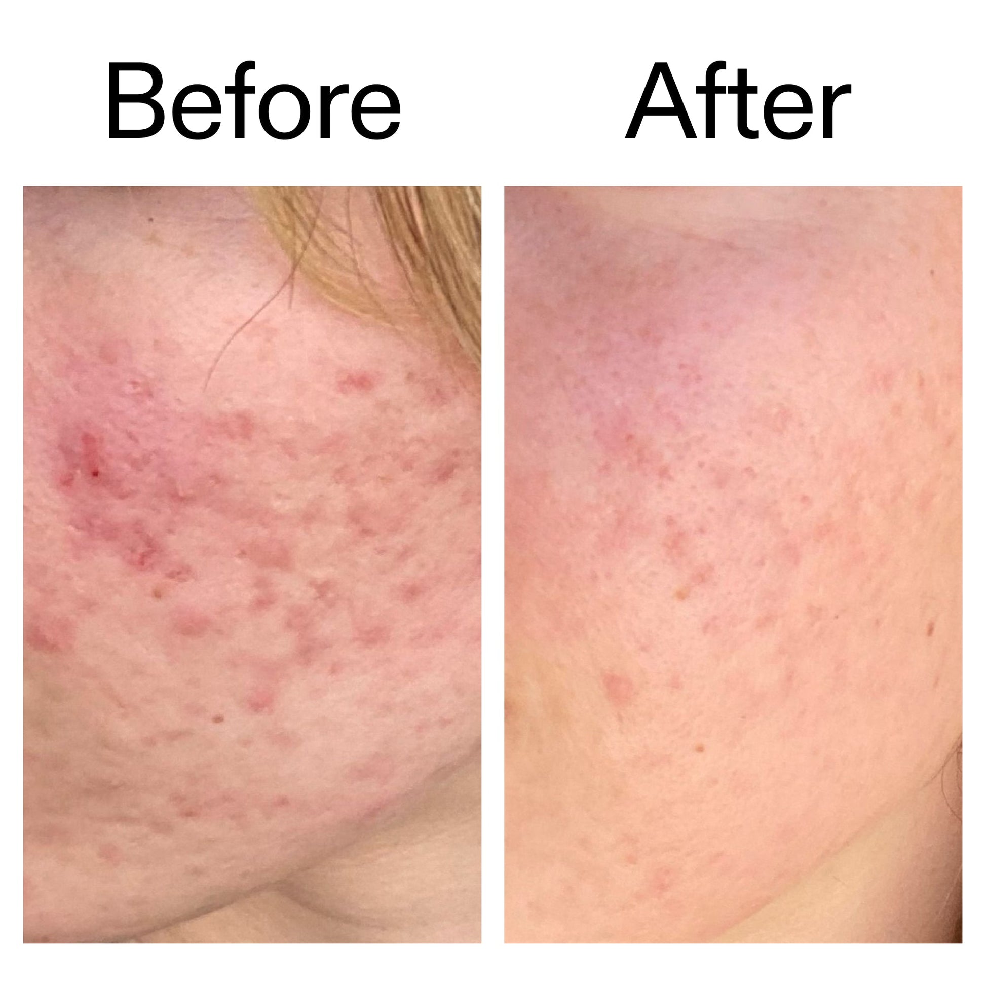 10-azelaic-acid-serum-for-redness-relief-l3 Azealic_Acid_Serum_B_A_Ppage_2000_x_2000.jpg