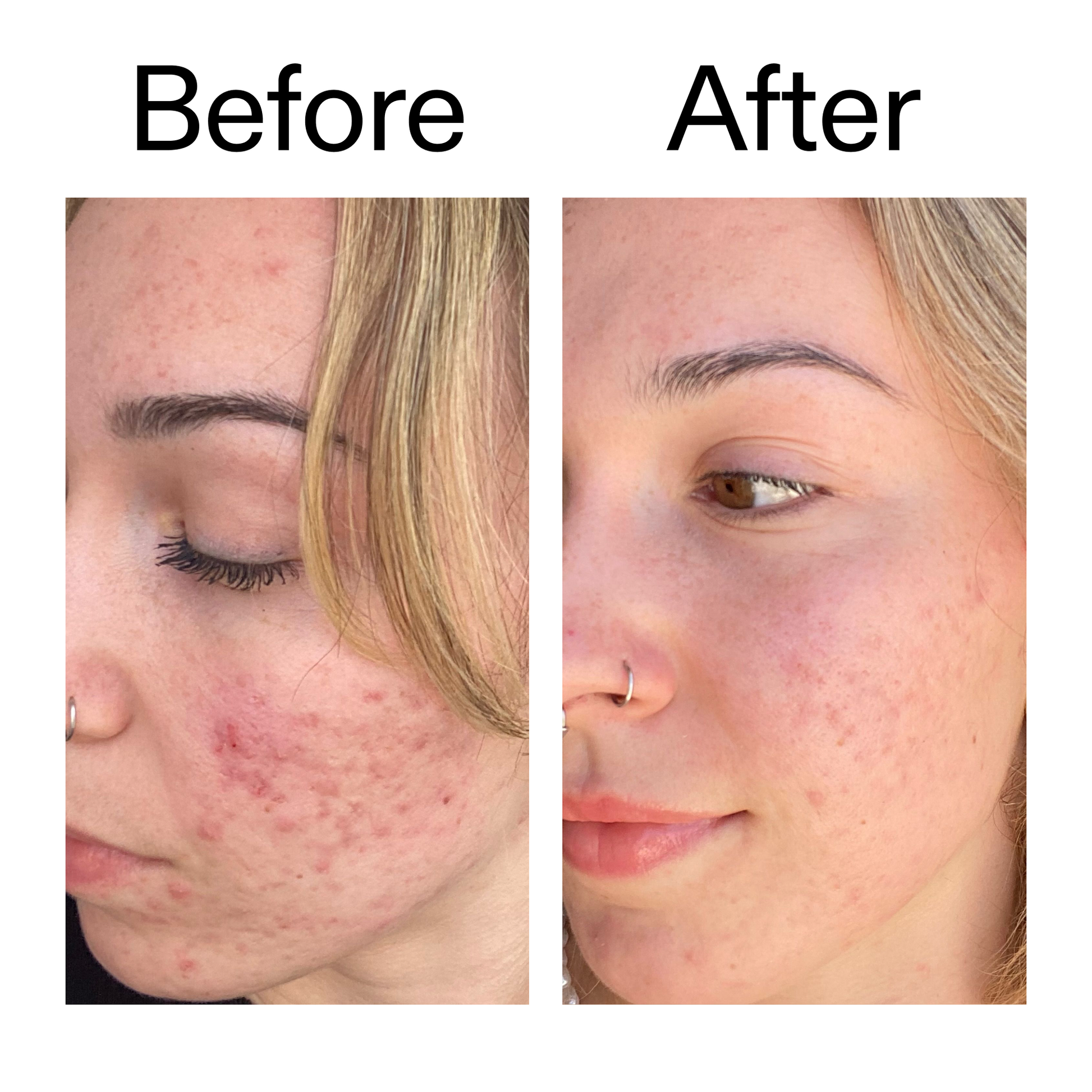 10-azelaic-acid-serum-for-redness-relief-l3 B_A_2_PPAGE.png