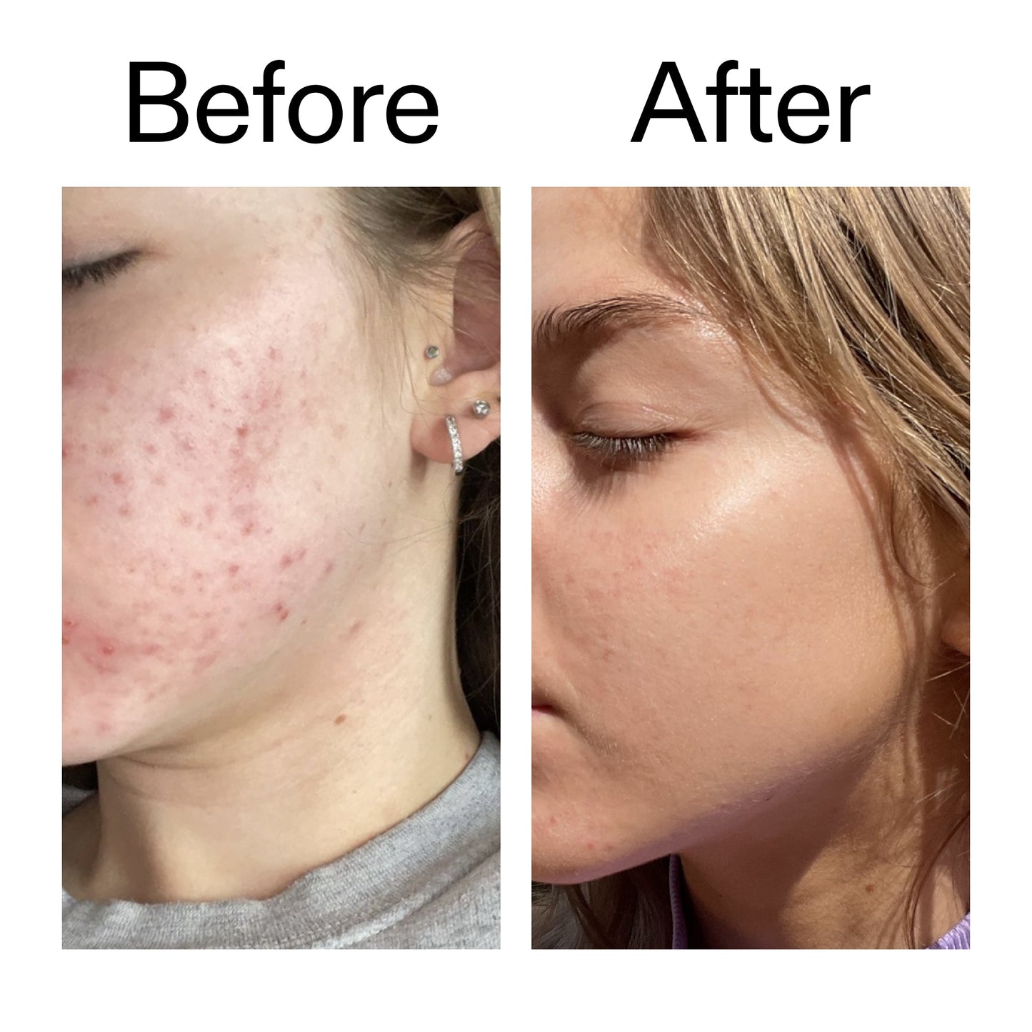beta-hydroxy-acid-bha-serum-w4 Beta_Hydroxy_Acid_Serum_Before_After_2000x2000_96fda3e5-938d-49ef-bcf2-a0fa6ece4e2c.jpg