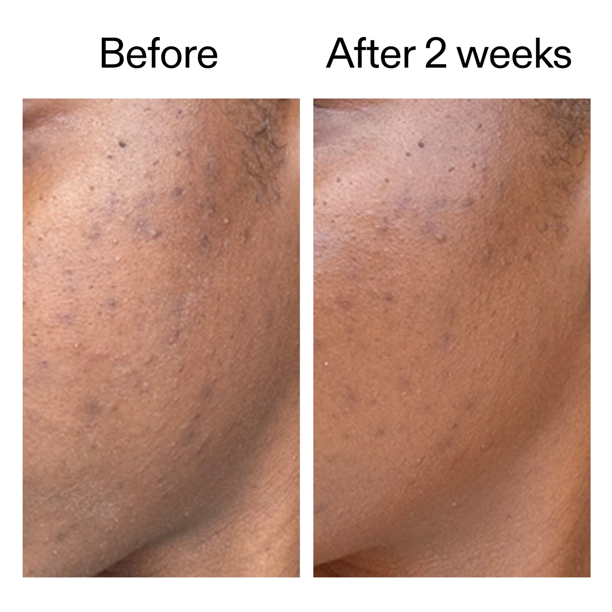 360-acne-clearing-duo-a2 DIOICB_A2000x2000.jpg