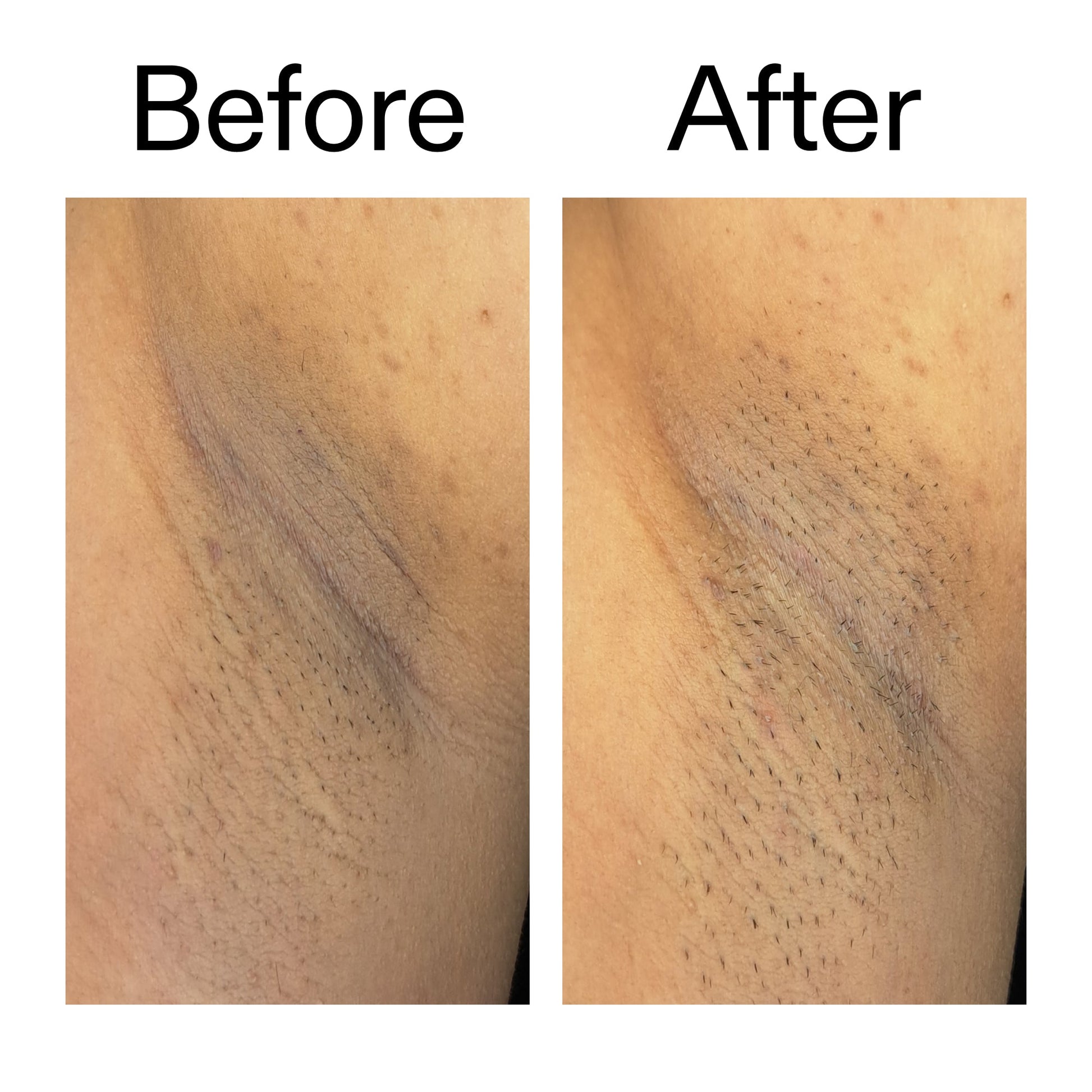 glycolic-acid-exfoliating-body-stick-duo-e1 Glycolic_Acid_Exfoliating_Body_Stick_Before_After_V3_2000x2000_ea919cd9-1439-4a46-82a0-76200eb5bb42.jpg