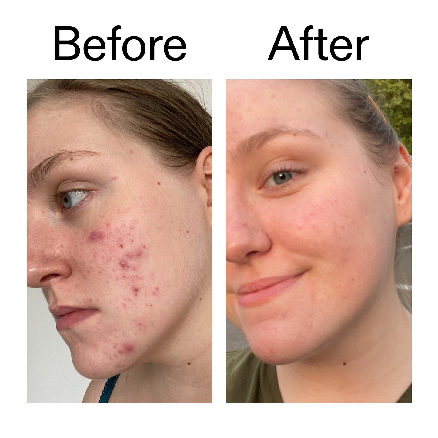 glycolic-acid-toner-c9 Glycolic_Acid_Toner_Before_After_2000x2000_49f0b9f7-e71b-4b2e-a8f8-2ea4b73247bb.jpg