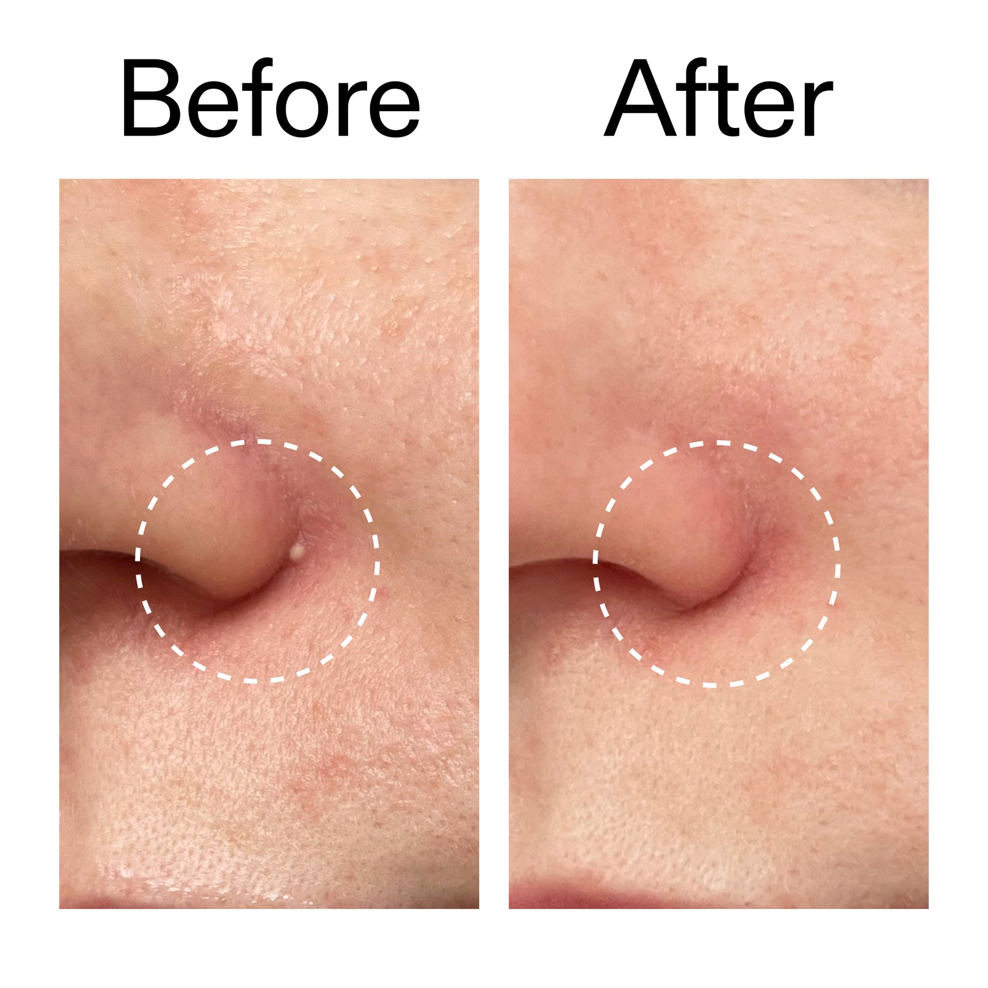 hydrocolloid-invisible-pimple-patches-pack-of-44-s7 Hydrocolloid_Invisible_Pimple_Patches_Before_After_2000x2000_b02aa37b-c78a-4682-91de-9135af5bb7df.jpg