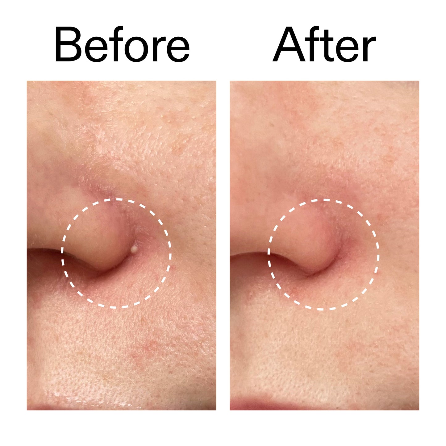 hydrocolloid-invisible-pimple-patches-pack-of-22-m2 Hydrocolloid_Invisible_Pimple_Patches_Before_After_2000x2000_b02aa37b-c78a-4682-91de-9135af5bb7df.jpg