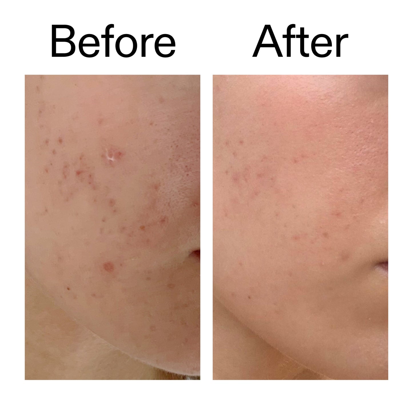 mandelic-acid-treatment-t8 Mandelic_Acid_Treatment_Before_After_2000x2000_4885ac6e-c5d7-4279-a72a-1417af7dce35.jpg