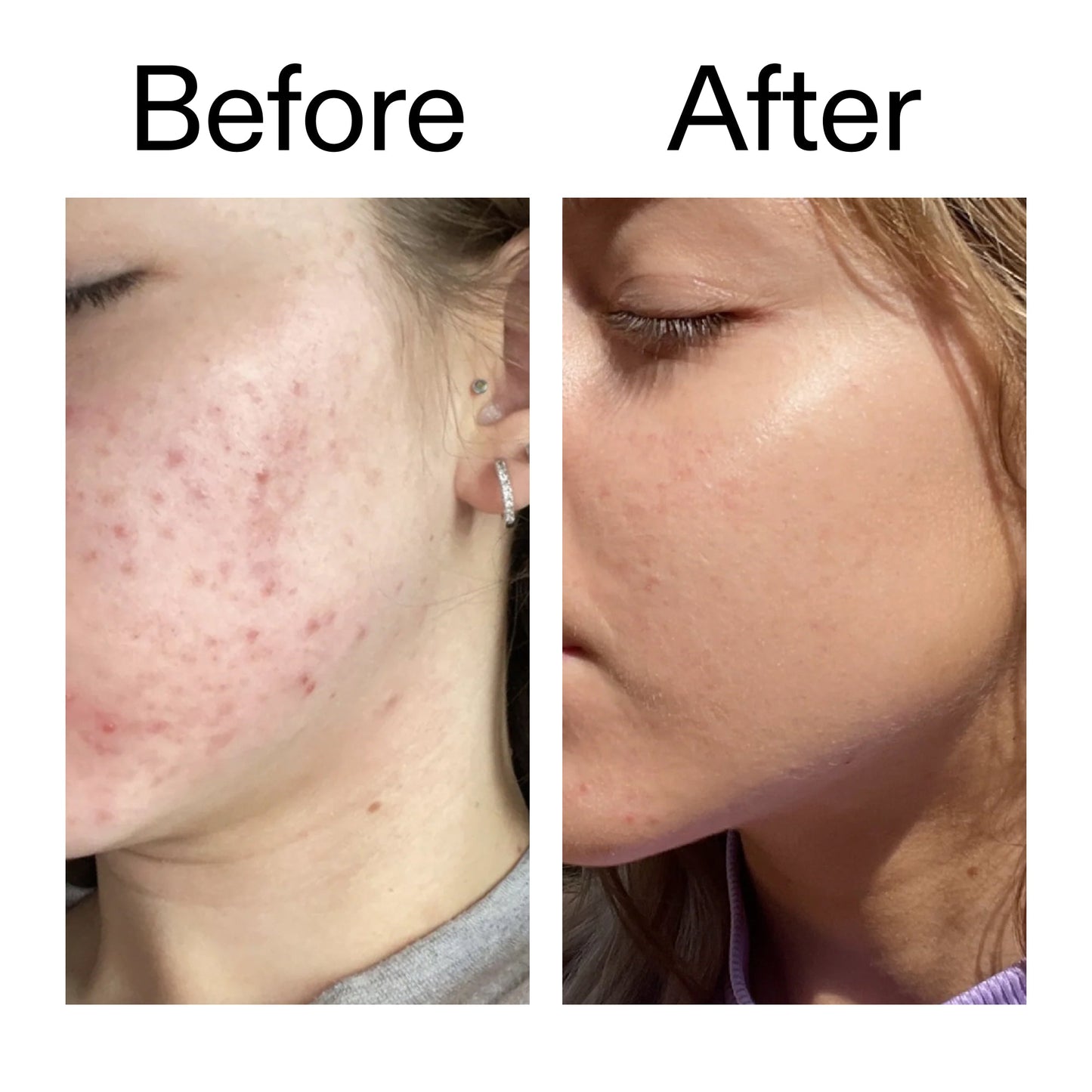 10-niacinamide-serum-p4 Niacinamide_Serum_Before_After_2000x2000_bde32455-9e7d-448e-b053-bef41504f0a9.jpg