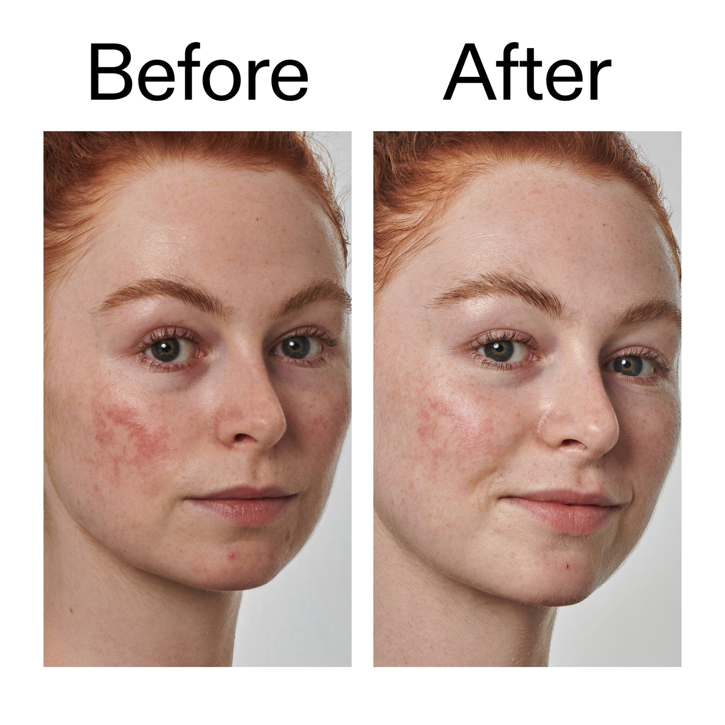 10-azelaic-acid-serum-for-redness-relief-l3 Redness_Relief_Serum_Before_After_2000x2000_3334dc9a-cce9-4e00-8aec-7ad89ca051f2.jpg