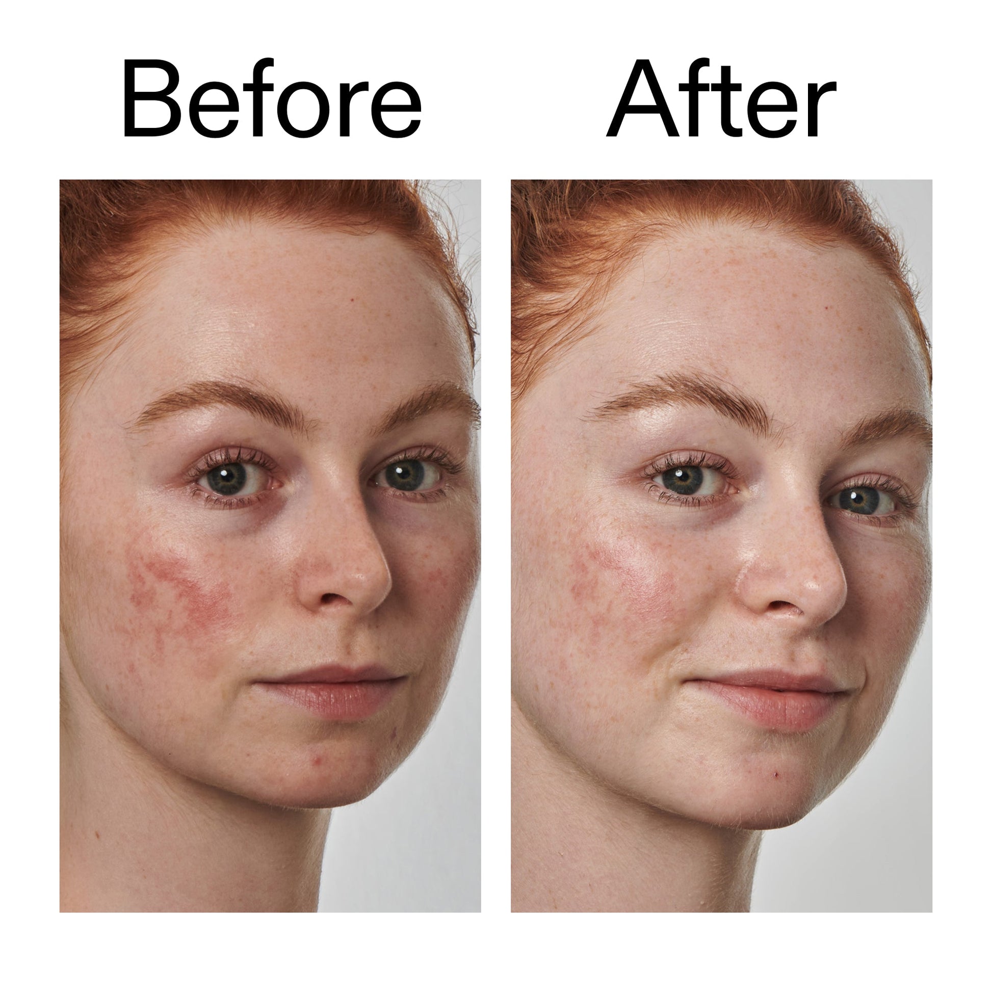 10-azelaic-acid-serum-for-redness-relief-l3 Redness_Relief_Serum_Before_After_2000x2000_3334dc9a-cce9-4e00-8aec-7ad89ca051f2.jpg