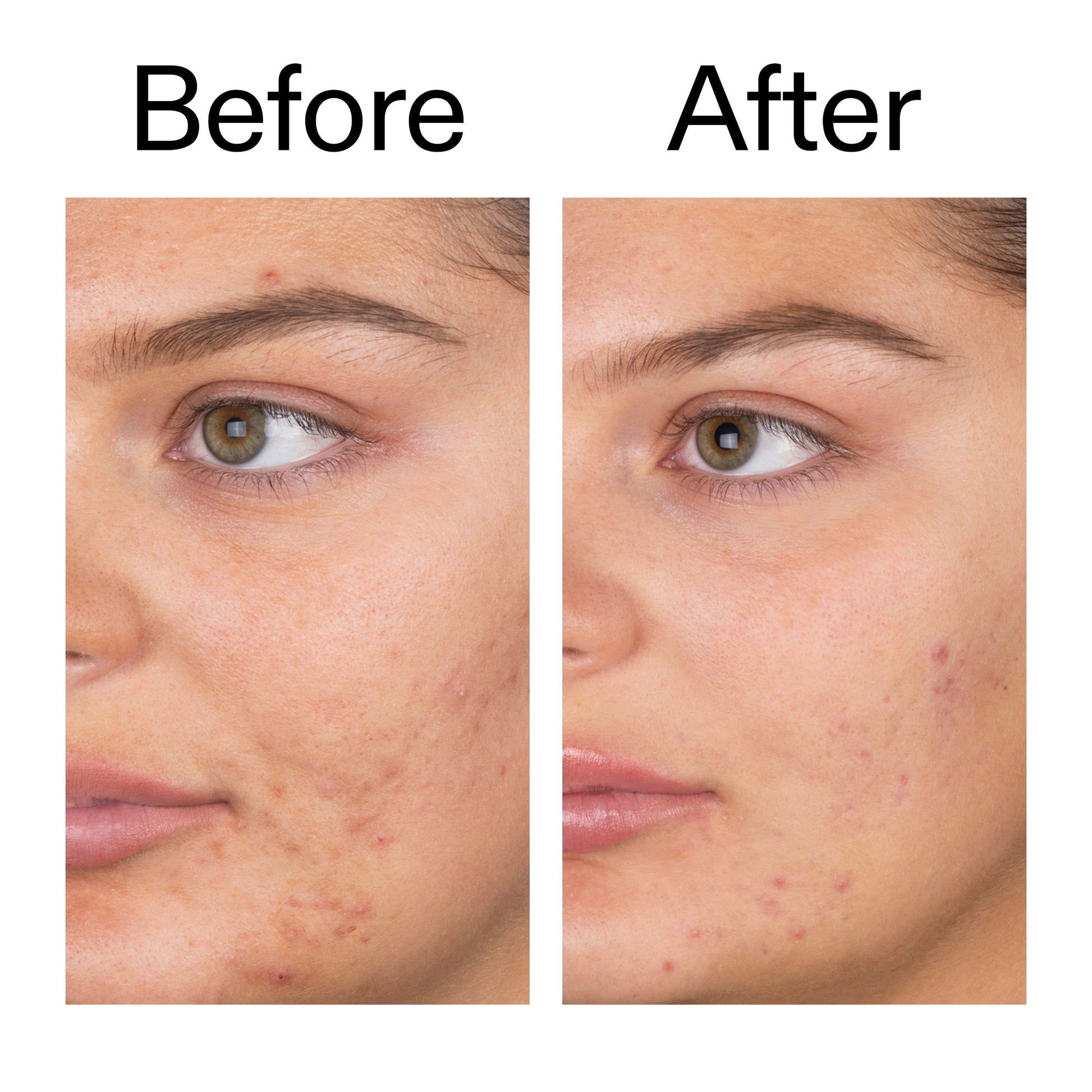 salicylic-acid-cleanser-150ml-p8 Salicylic_Acid_Cleanser_-_150ml_Before_After_2000x2000_e7230494-853f-4b07-82b1-27669104c995.jpg