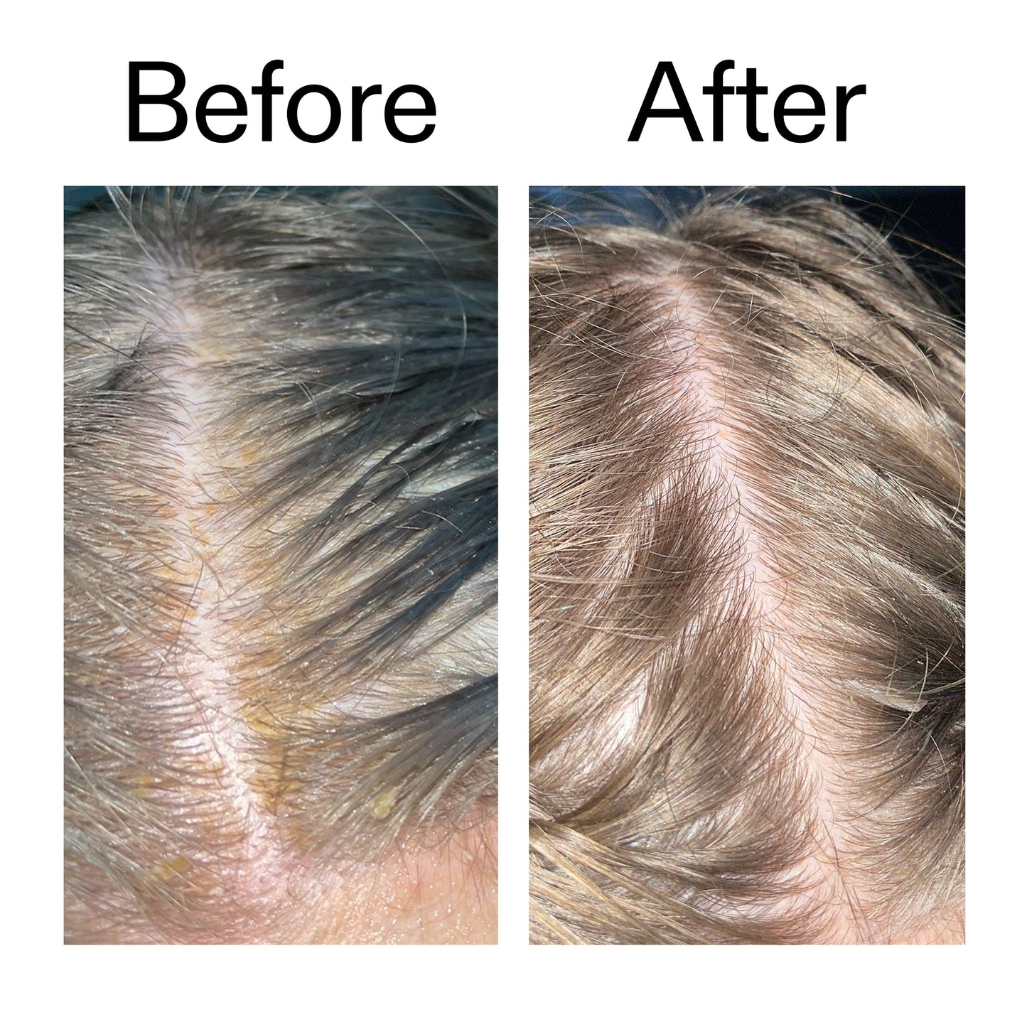 salicylic-acid-exfoliating-scalp-treatment-f2 Salicylic_Acid_Exfoliating_Scalp_Treatment_Before_After_2000x2000_e572a30f-057c-4a48-823b-1c09dc97f8d0.jpg