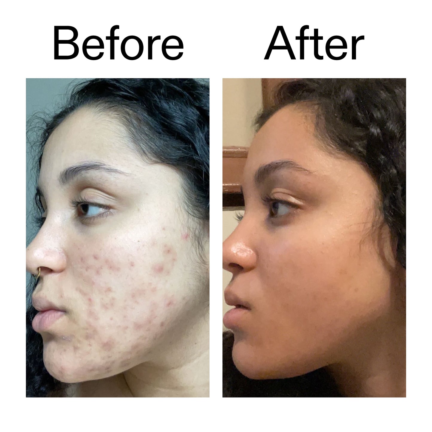 tranexamic-acid-serum-v6 Tranexamic_Acid_Serum_Before_After_2000x2000_98ebc8be-77b0-4843-8a22-90790ebe918b.jpg